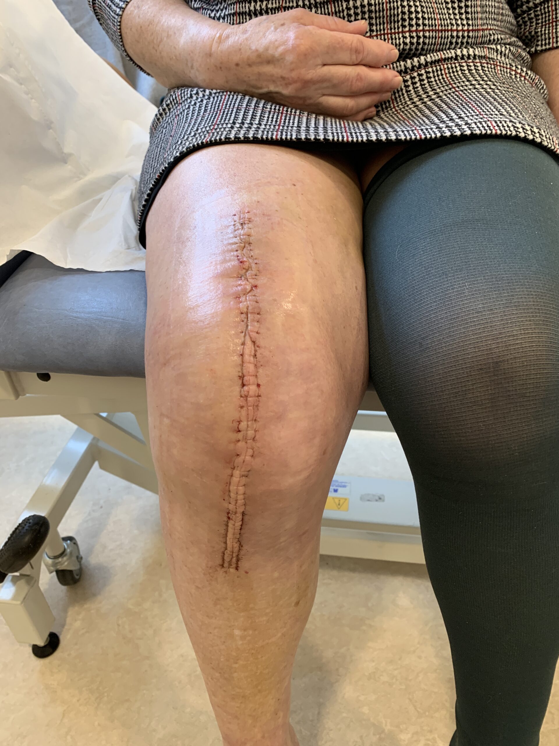 knee replacement