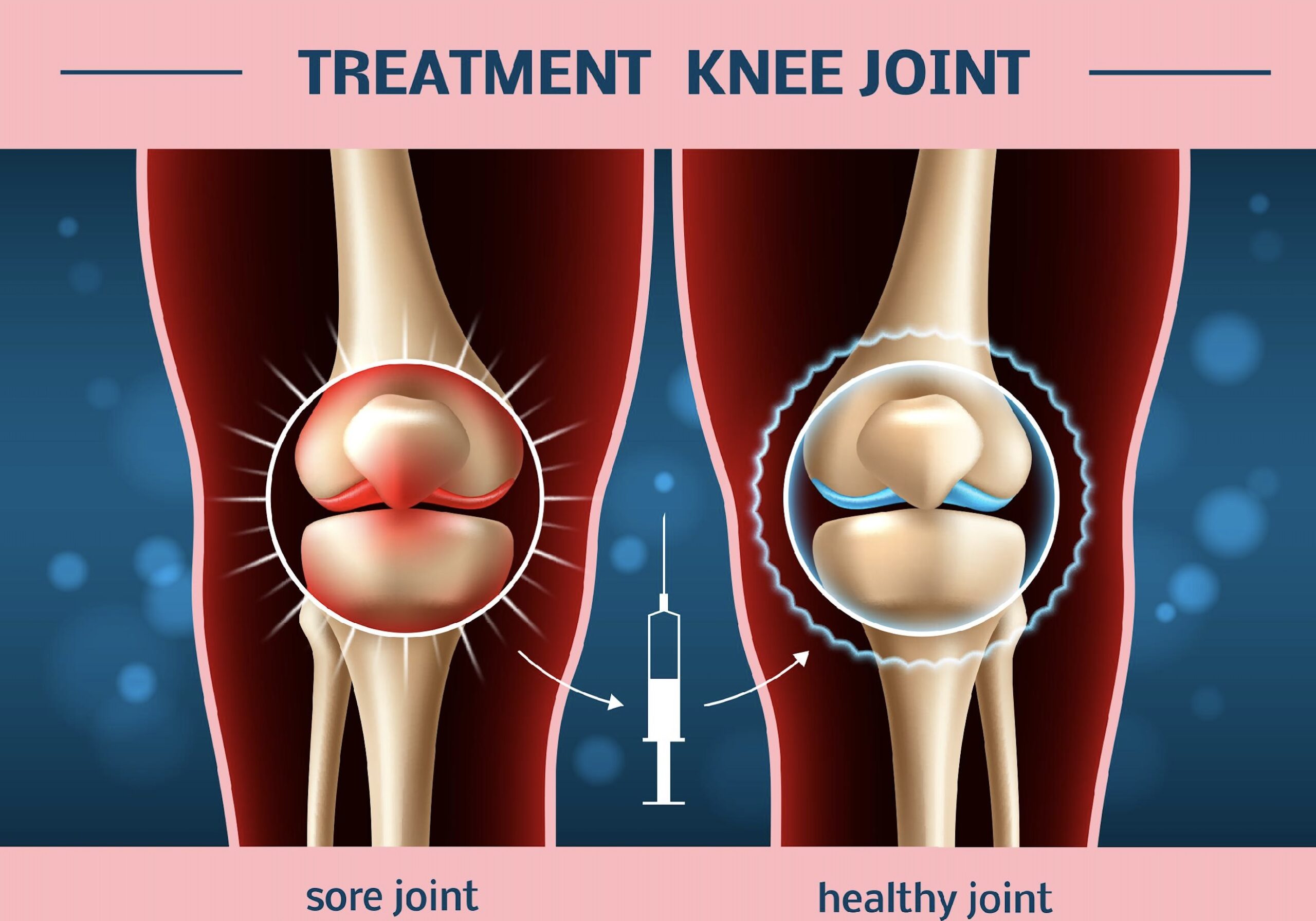Painless Knee Joint Injection Treatment