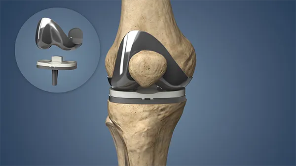 Birmingham Knee Replacement | Expert Partial, Total & Robotic Care