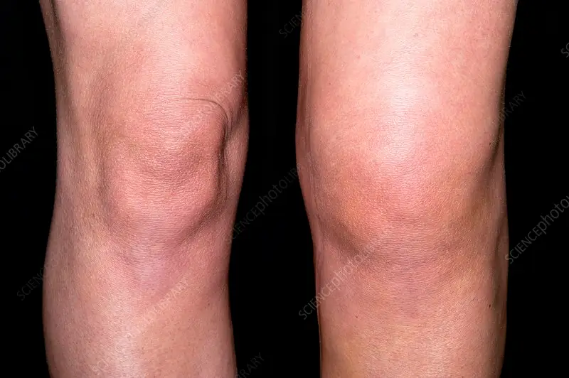 KNEE SWELLING