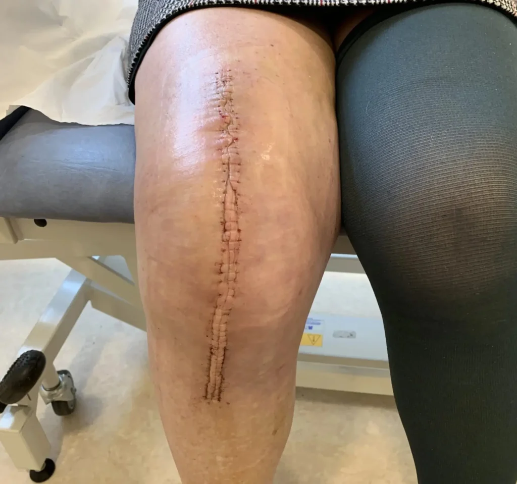 Knee Replacement Scaled